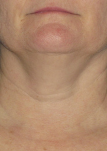 Ultherapy Neck Before