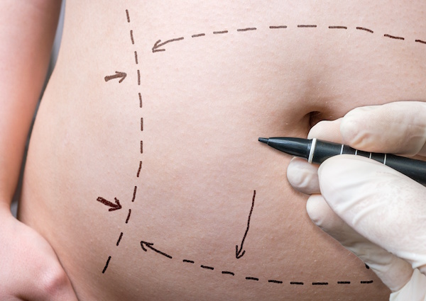 Allure Plastic Surgery Blog | 5 Medical Benefits of a Tummy Tuck