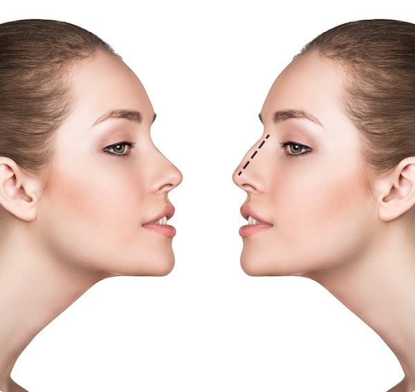Allure Plastic Surgery Blog | Considering Rhinoplasty: Advantages and Disadvantages