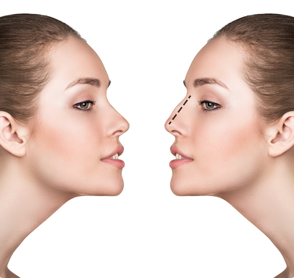 Rhinoplasty New York