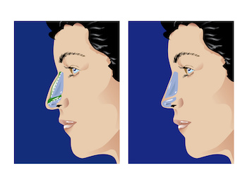 Manhattan Rhinoplasty