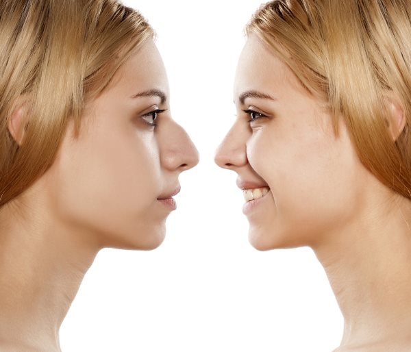 Allure Plastic Surgery Blog | 12 Important Topics to Cover at Your Rhinoplasty Surgical Consultation