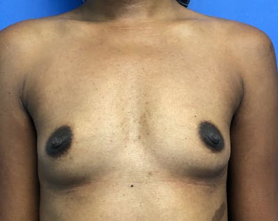 Breast Augmentation Before & After Gallery - Patient 5883052 - Image 1
