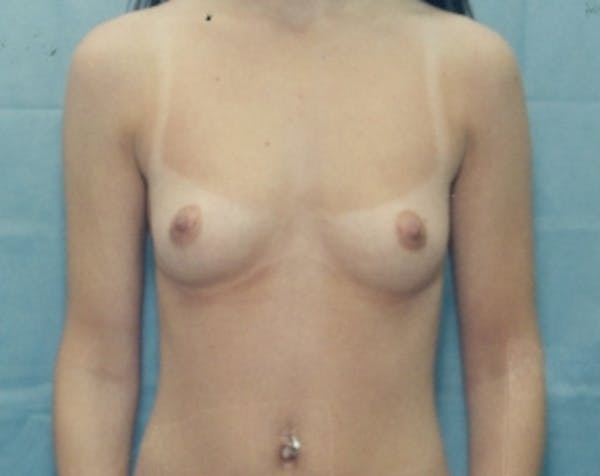 Breast Augmentation Before & After Gallery - Patient 5883063 - Image 1