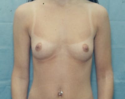 Breast Augmentation Before & After Gallery - Patient 5883063 - Image 1