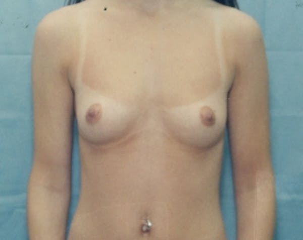 Breast Augmentation Gallery - Patient 5883063 - Image 1