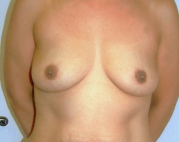 Breast Augmentation Before & After Gallery - Patient 5883065 - Image 1