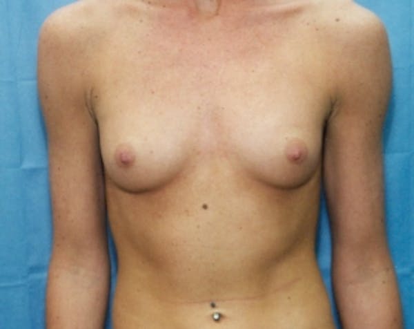 Breast Augmentation Before & After Gallery - Patient 5883068 - Image 1