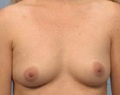 Breast Augmentation Before & After Gallery - Patient 5883069 - Image 1