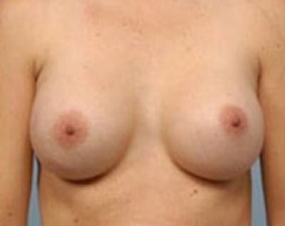 Breast Augmentation Before & After Gallery - Patient 5883069 - Image 2