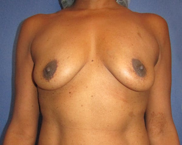 Breast Augmentation Before & After Gallery - Patient 5883070 - Image 1