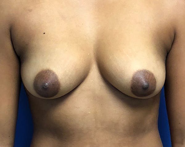 Breast Augmentation Before & After Gallery - Patient 5883169 - Image 1