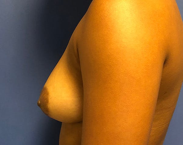 Breast Augmentation Before & After Gallery - Patient 5883169 - Image 3