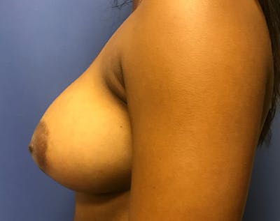 Breast Augmentation Before & After Gallery - Patient 5883169 - Image 4
