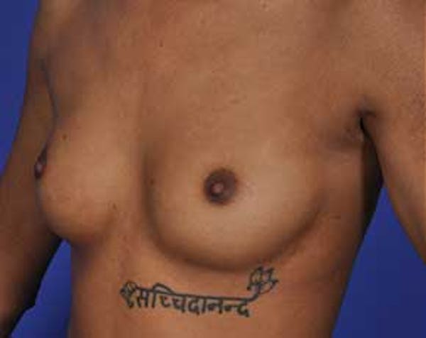 Breast Augmentation Gallery - Patient 5883171 - Image 1