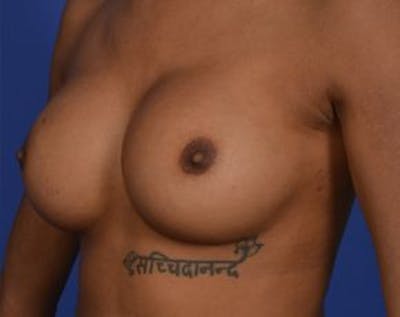 Breast Augmentation Before & After Gallery - Patient 5883171 - Image 2