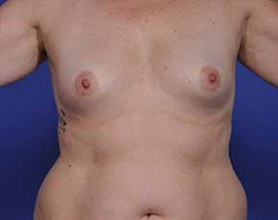 Breast Augmentation Before & After Gallery - Patient 5883175 - Image 1