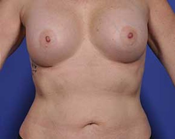 Breast Augmentation Before & After Gallery - Patient 5883175 - Image 2