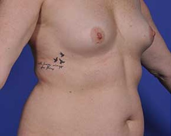 Breast Augmentation Before & After Gallery - Patient 5883175 - Image 3