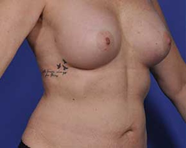 Breast Augmentation Before & After Gallery - Patient 5883175 - Image 4