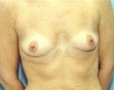 Breast Augmentation Before & After Gallery - Patient 5883181 - Image 1