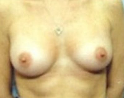 Breast Augmentation Before & After Gallery - Patient 5883181 - Image 2