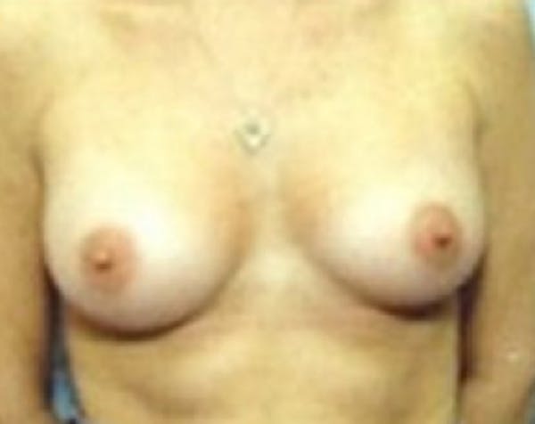 Breast Augmentation Before & After Gallery - Patient 5883181 - Image 2