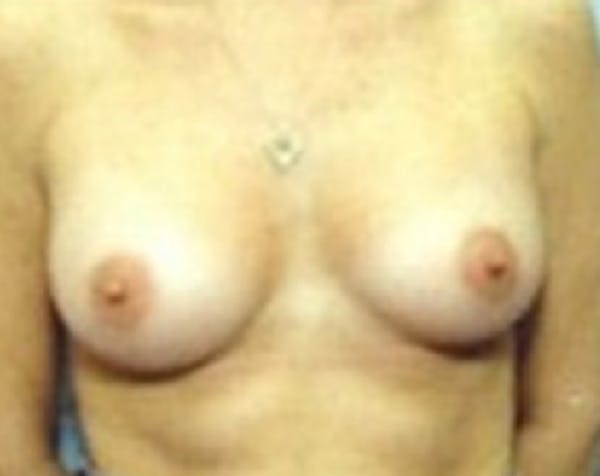 Breast Augmentation Gallery - Patient 5883181 - Image 2