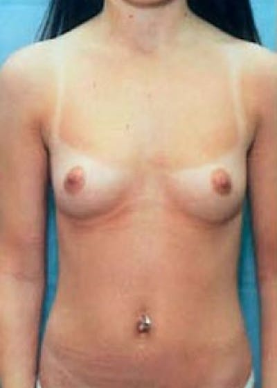 Breast Augmentation Before & After Gallery - Patient 5883183 - Image 1