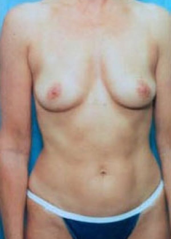 Breast Augmentation Before & After Gallery - Patient 5883192 - Image 1
