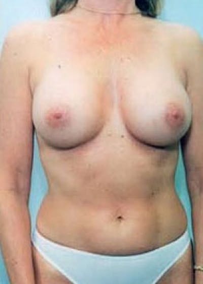 Breast Augmentation Before & After Gallery - Patient 5883192 - Image 2