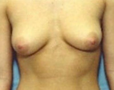 Breast Augmentation Before & After Gallery - Patient 5883194 - Image 1