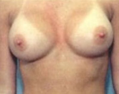 Breast Augmentation Before & After Gallery - Patient 5883194 - Image 2