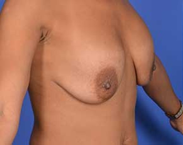 Before and After Breast Lift in NYC