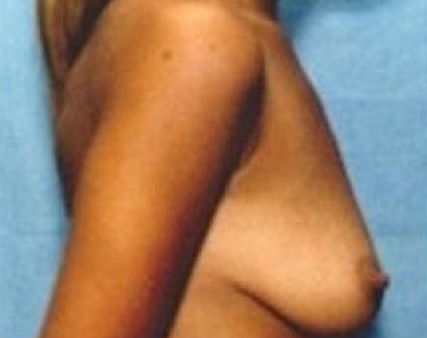 Breast Augmentation Before & After Gallery - Patient 5883223 - Image 1