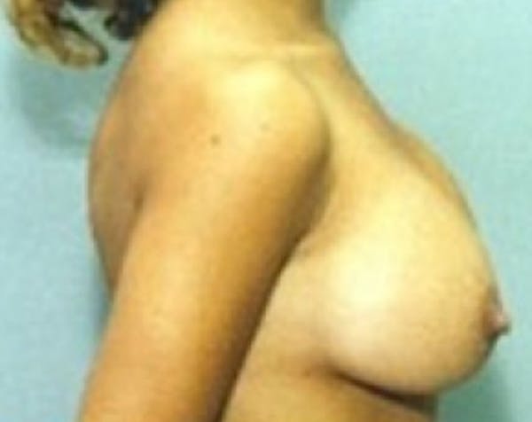 Breast Augmentation Before & After Gallery - Patient 5883223 - Image 2