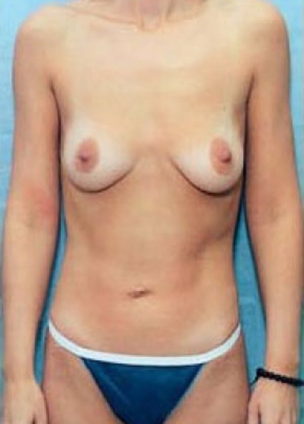 Breast Augmentation Before & After Gallery - Patient 5883225 - Image 1