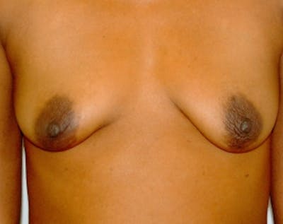 Breast Augmentation Before & After Gallery - Patient 5883228 - Image 1