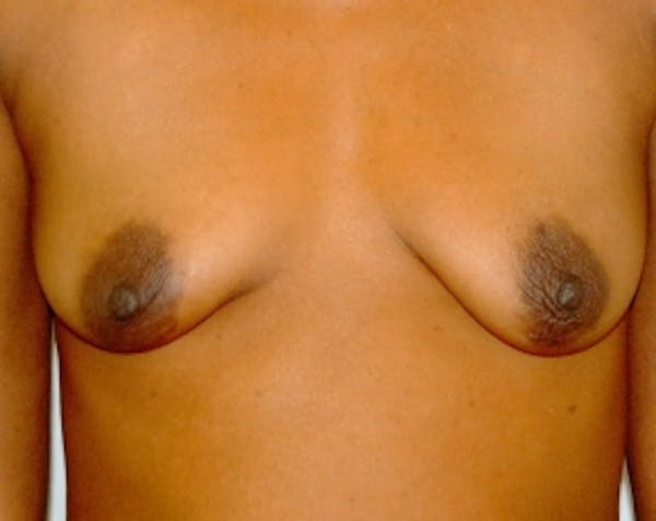 Breast Augmentation Before & After Gallery - Patient 5883228 - Image 1