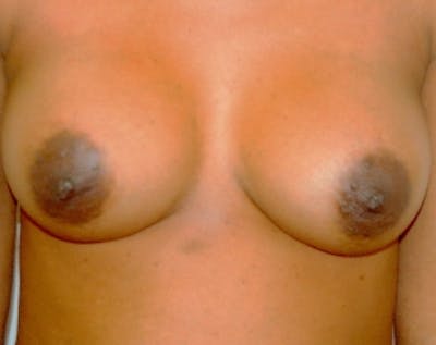 Breast Augmentation Before & After Gallery - Patient 5883228 - Image 2