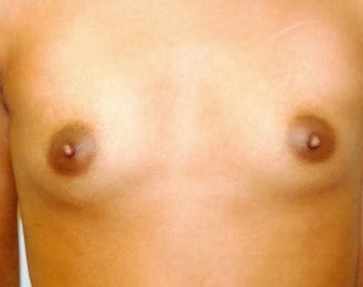 Breast Augmentation Before & After Gallery - Patient 5883231 - Image 1