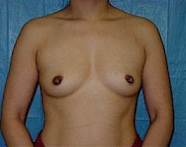 Breast Augmentation Before & After Gallery - Patient 5883232 - Image 1