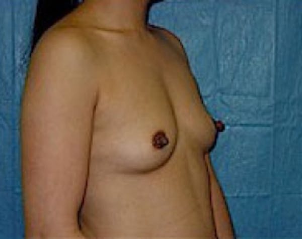 Breast Augmentation Before & After Gallery - Patient 5883232 - Image 3