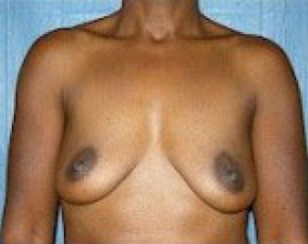 Breast Augmentation Before & After Gallery - Patient 5883233 - Image 1