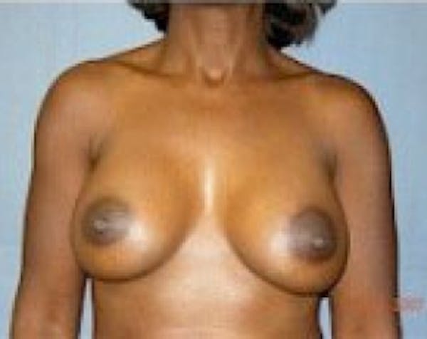 Breast Augmentation Before & After Gallery - Patient 5883233 - Image 2