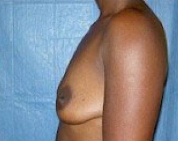 Breast Augmentation Before & After Gallery - Patient 5883233 - Image 5