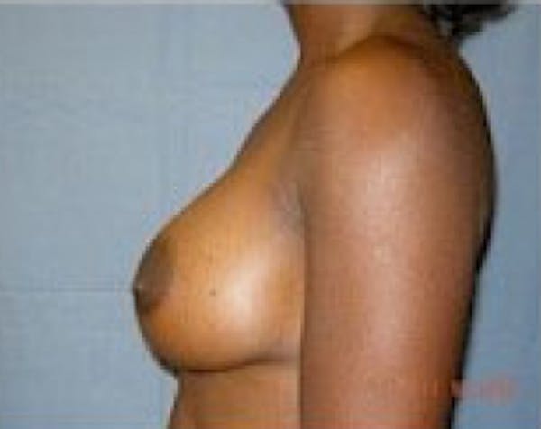 Breast Augmentation Before & After Gallery - Patient 5883233 - Image 6