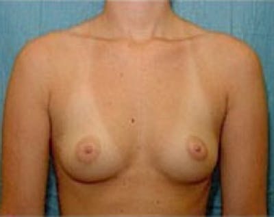 Breast Augmentation Before & After Gallery - Patient 5883237 - Image 1