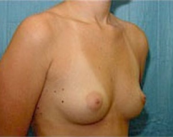Breast Augmentation Before & After Gallery - Patient 5883237 - Image 3