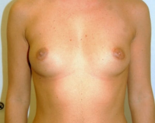Breast Augmentation Before & After Gallery - Patient 5883238 - Image 1
